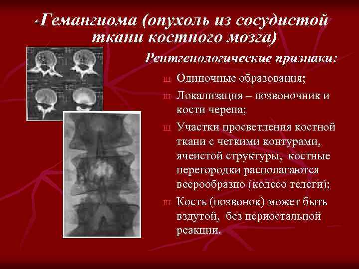 Гемангиома (опухоль из сосудистой ткани костного мозга) Рентгенологические признаки: Ш Ш Одиночные образования; Локализация