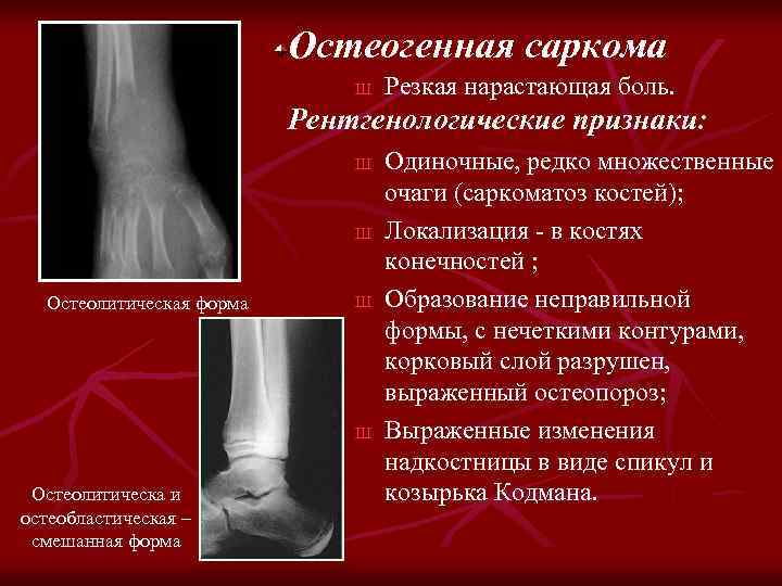 Остеогенная саркома Ш Резкая нарастающая боль. Рентгенологические признаки: Ш Ш Остеолитическая форма Ш Ш