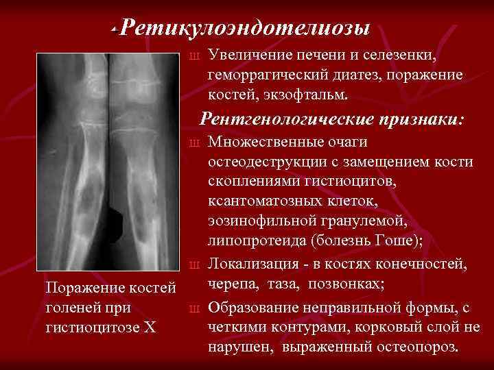 Ретикулоэндотелиозы Ш Увеличение печени и селезенки, геморрагический диатез, поражение костей, экзофтальм. Рентгенологические признаки: Ш