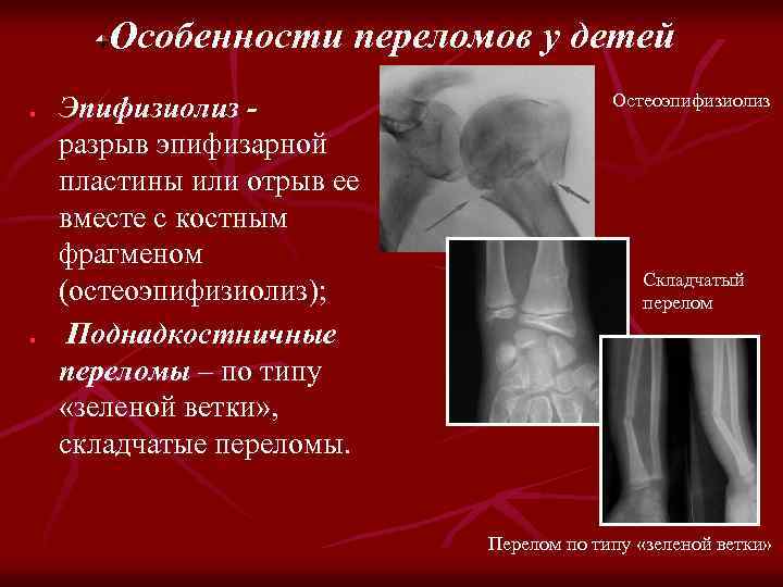 Особенности переломов у детей n n Эпифизиолиз разрыв эпифизарной пластины или отрыв ее вместе