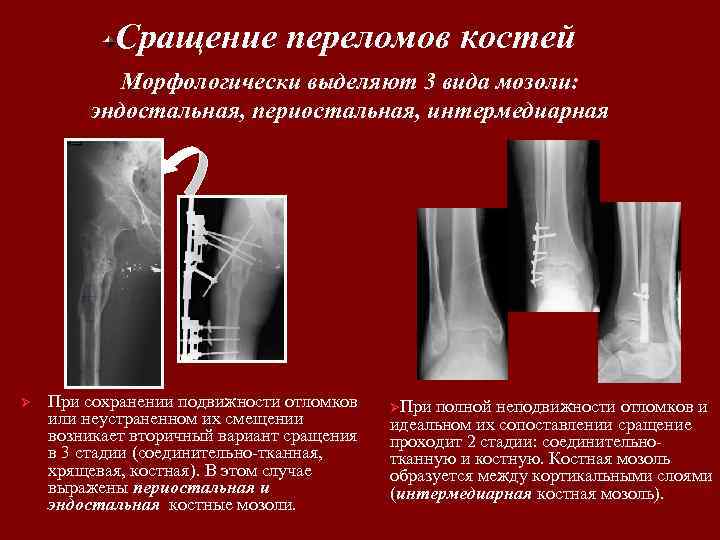 Срастание костей при переломе. Сращение переломов костей. Эндостальная костная мозоль. Сросшийся перелом кости. Для сращения костей при переломах.