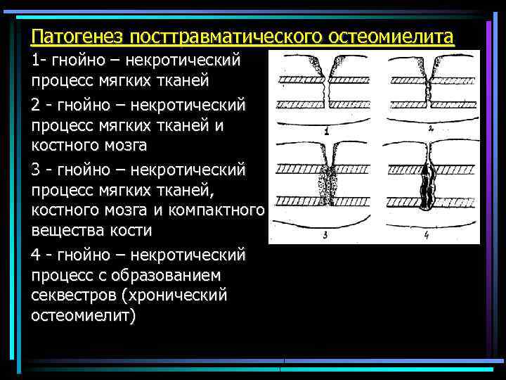 Патогенез посттравматического остеомиелита 1 - гнойно – некротический процесс мягких тканей 2 - гнойно