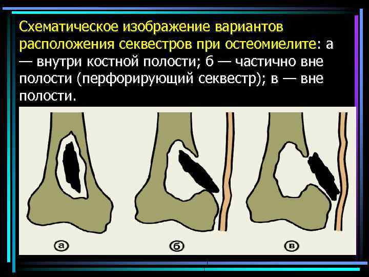 Схематическое изображение вариантов расположения секвестров при остеомиелите: а — внутри костной полости; б —