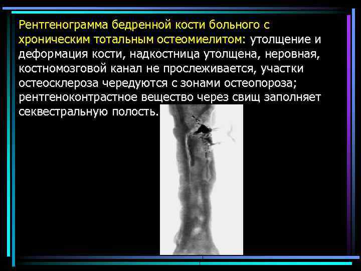 Рентгенограмма бедренной кости больного с хроническим тотальным остеомиелитом: утолщение и деформация кости, надкостница утолщена,