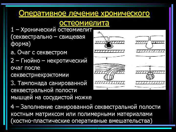 Оперативное лечение хронического остеомиелита 1 – Хронический остеомиелит (секвестрально – свищевая форма) а. Очаг