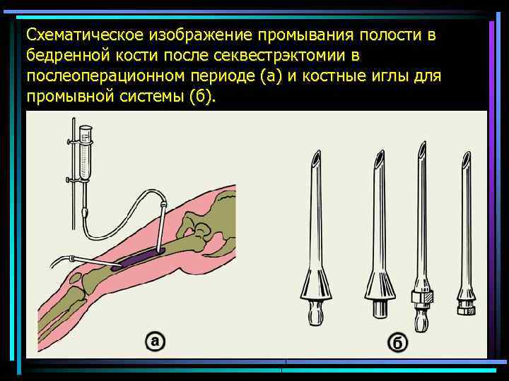 Схематическое изображение промывания полости в бедренной кости после секвестрэктомии в послеоперационном периоде (а) и