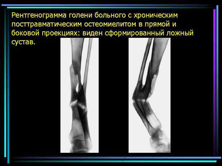 Рентгенограмма голени больного с хроническим посттравматическим остеомиелитом в прямой и боковой проекциях: виден сформированный
