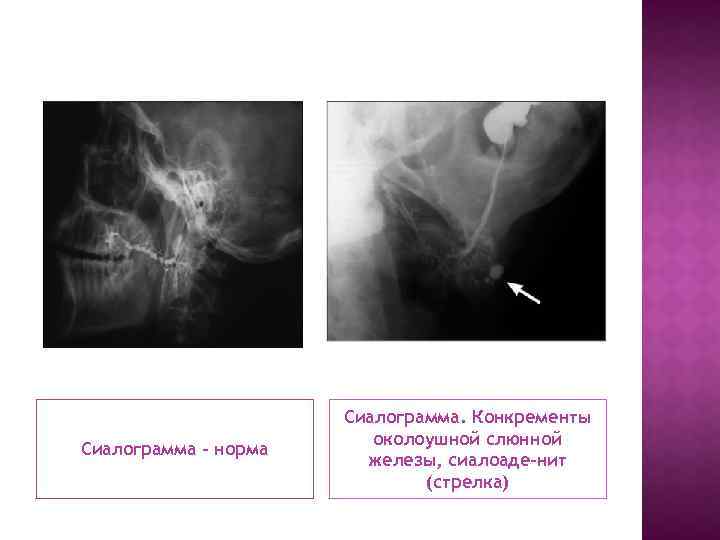 Сиалограмма - норма Сиалограмма. Конкременты околоушной слюнной железы, сиалоаде-нит (стрелка) 
