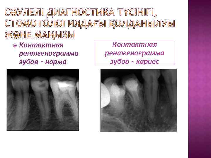  Контактная рентгенограмма зубов - норма Контактная рентгенограмма зубов - кариес 