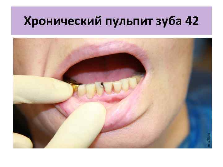 Хронический пульпит зуба 42 