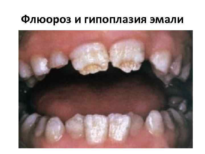 Флюороз и гипоплазия эмали 