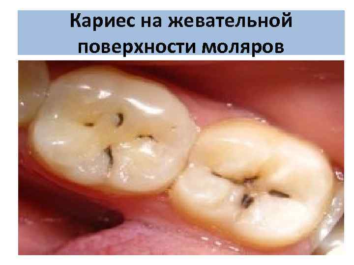 Кариес на жевательной поверхности моляров 