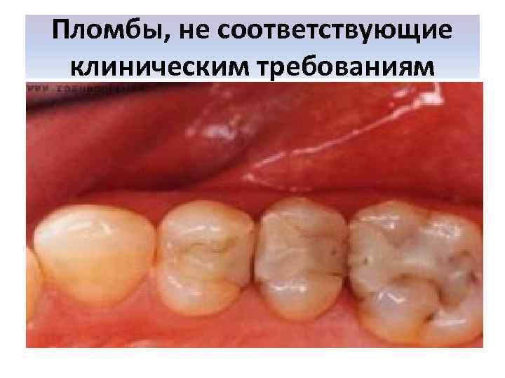 Пломбы, не соответствующие клиническим требованиям 