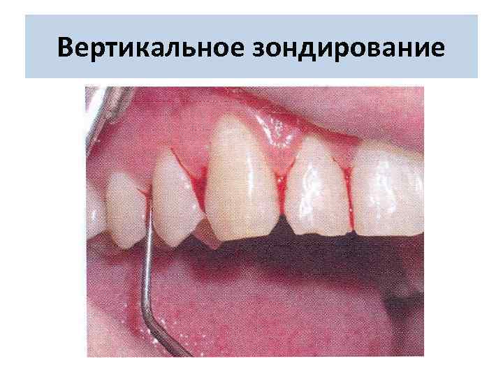 Вертикальное зондирование 