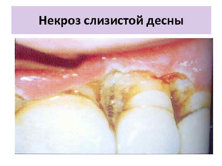 Некроз слизистой десны 