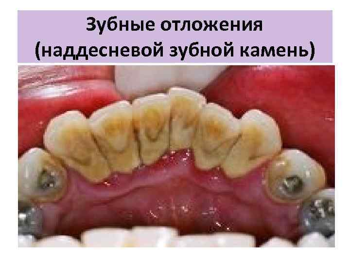 Зубные отложения (наддесневой зубной камень) 