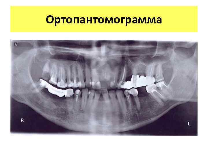 Ортопантомограмма 