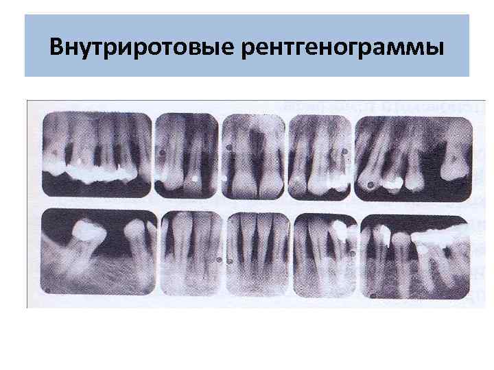 При недостаточной экспозиции на внутриротовых рентгенограммах изображение зубов получается цвета фон