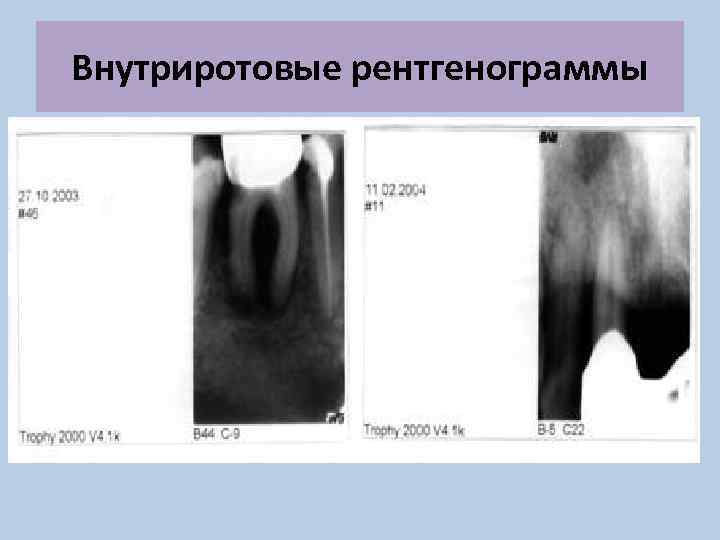 Внутриротовые рентгенограммы 