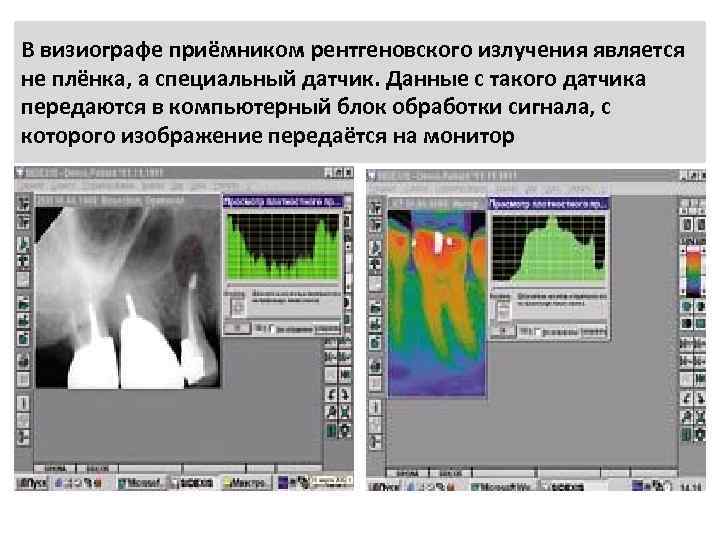В визиографе приёмником рентгеновского излучения является не плёнка, а специальный датчик. Данные с такого