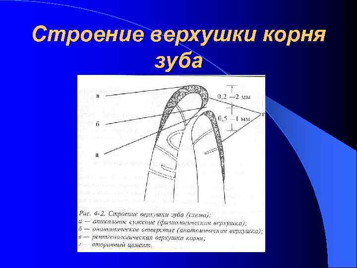 Схема резекции верхушки корня