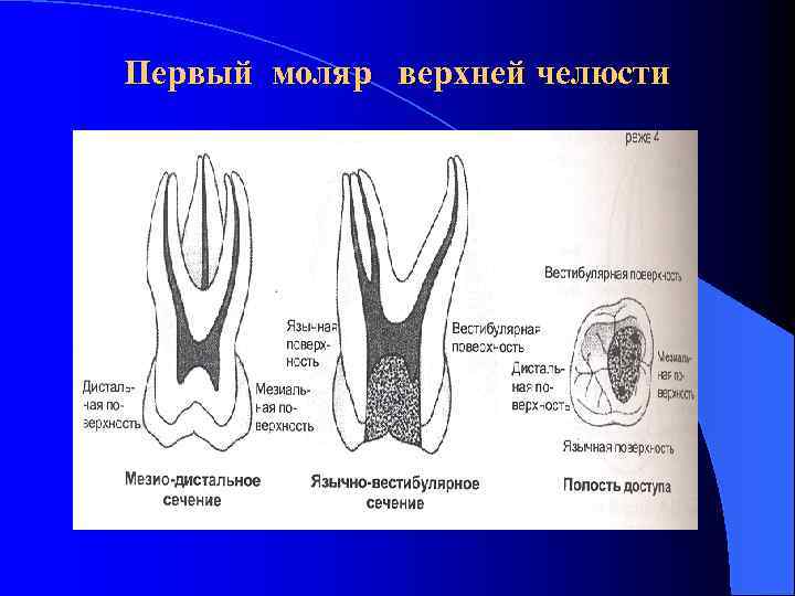 Первый моляр верхней челюсти 