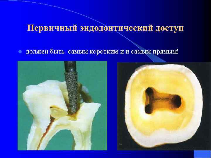Первичный эндодонтический доступ l должен быть самым коротким и и самым прямым! 