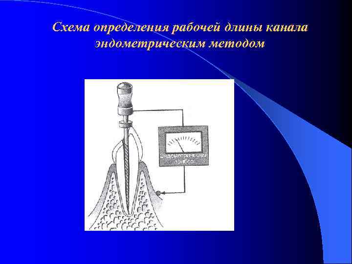 Схема определения рабочей длины канала эндометрическим методом 