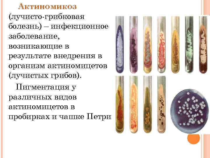 Актиномикоз (лучисто-грибковая болезнь) – инфекционное заболевание, возникающие в результате внедрения в организм актиномицетов (лучистых