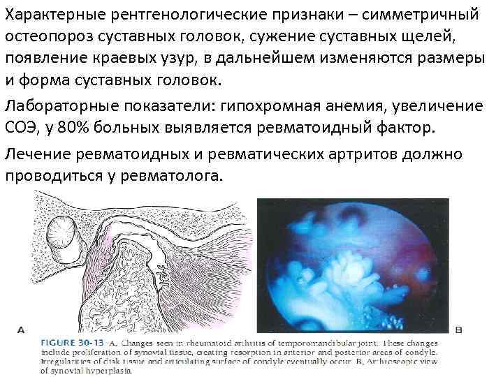 Рентгенологическая картина при хронических артритах височно нижнечелюстного сустава