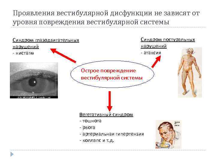 Проявления вестибулярной дисфункции не зависят от уровня повреждения вестибулярной системы Синдром глазодвигательных нарушений -