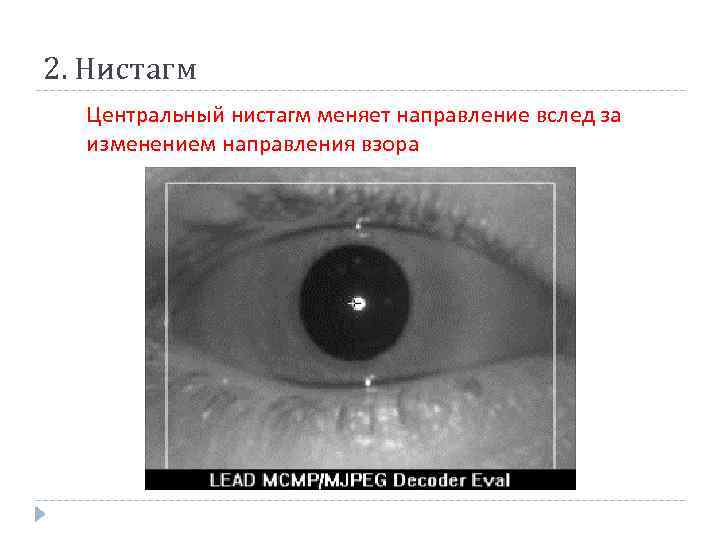 2. Нистагм Центральный нистагм меняет направление вслед за изменением направления взора 
