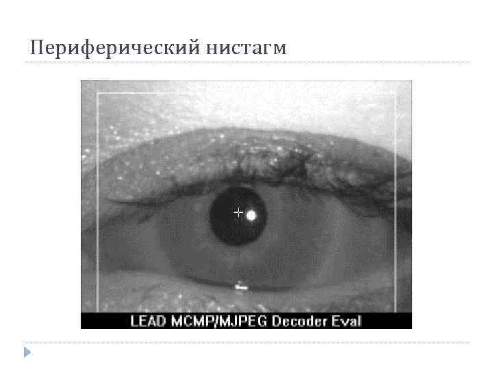Периферический нистагм 