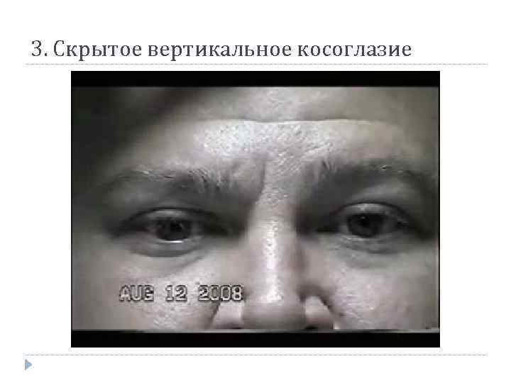 3. Скрытое вертикальное косоглазие 
