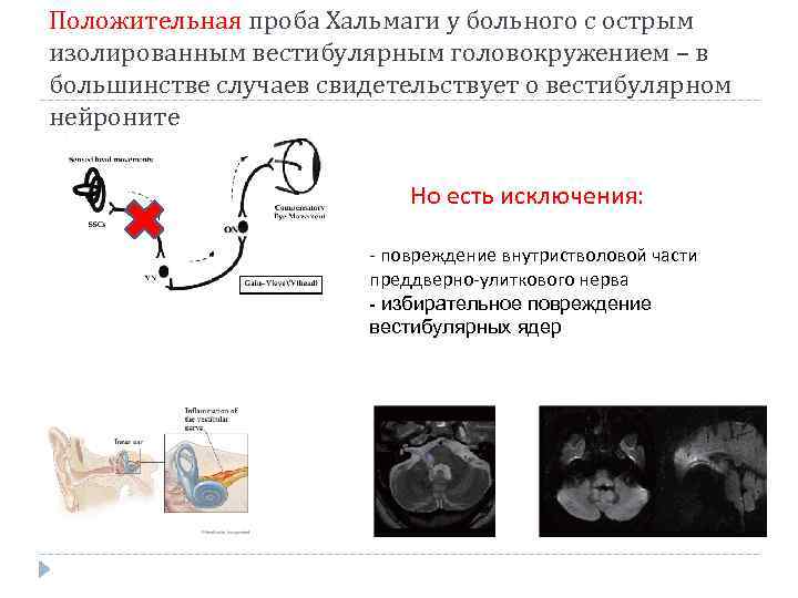 Положительная проба Хальмаги у больного с острым изолированным вестибулярным головокружением – в большинстве случаев