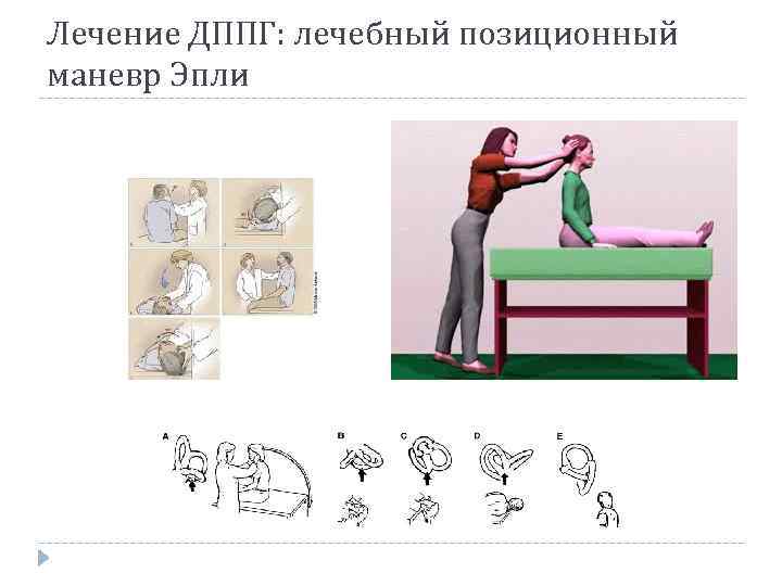 Лечение ДППГ: лечебный позиционный маневр Эпли 