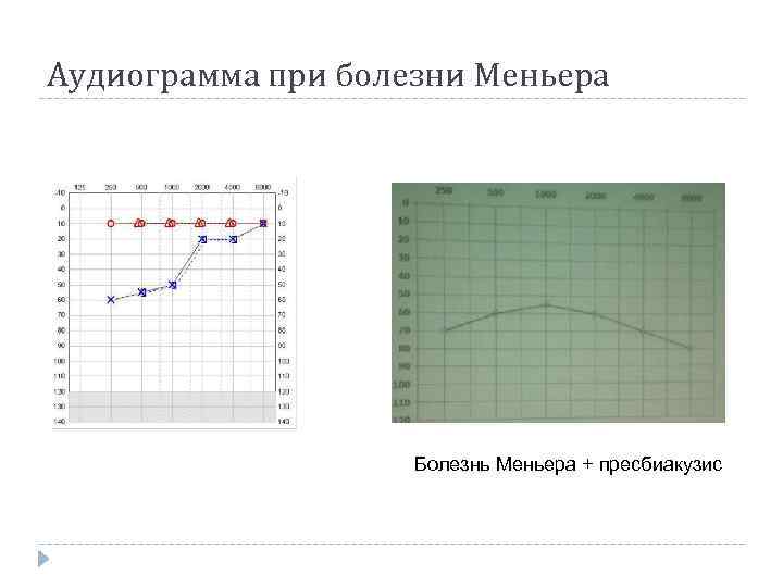 Аудиограмма при болезни Меньера Болезнь Меньера + пресбиакузис 