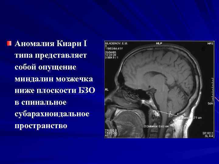 Аномалия Киари I типа представляет собой опущение миндалин мозжечка ниже плоскости БЗО в спинальное