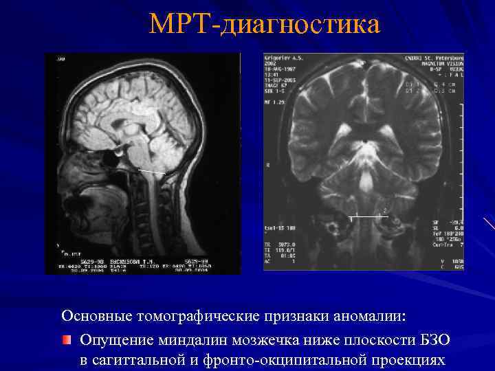 MРТ-диагностика Основные томографические признаки аномалии: Опущение миндалин мозжечка ниже плоскости БЗО в сагиттальной и