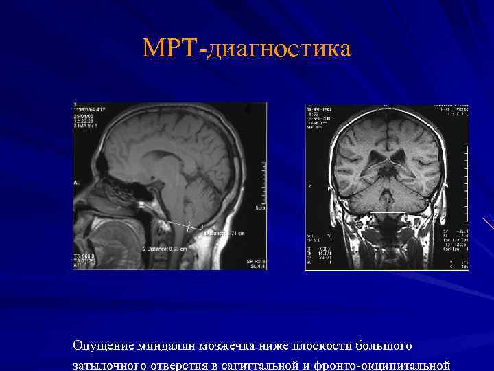 МРТ-диагностика Опущение миндалин мозжечка ниже плоскости большого затылочного отверстия в сагиттальной и фронто-окципитальной 