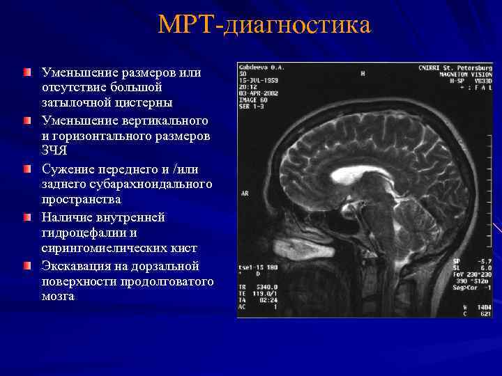 MРТ-диагностика Уменьшение размеров или отсутствие большой затылочной цистерны Уменьшение вертикального и горизонтального размеров ЗЧЯ