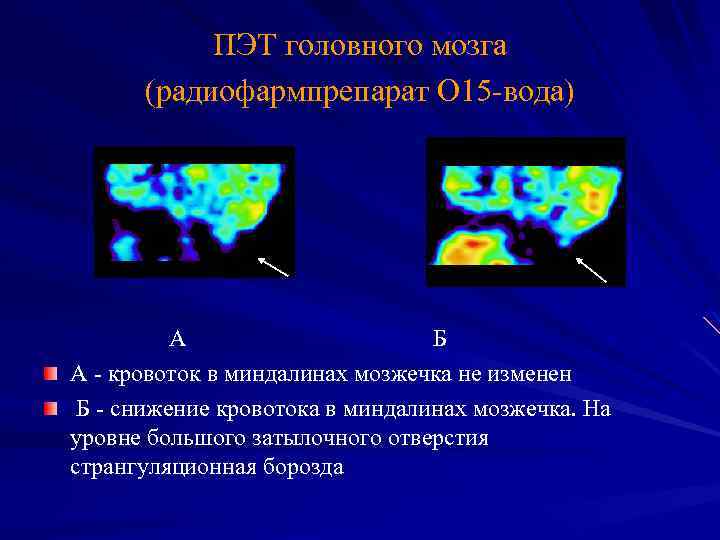 ПЭТ головного мозга (радиофармпрепарат О 15 -вода) А Б А - кровоток в миндалинах