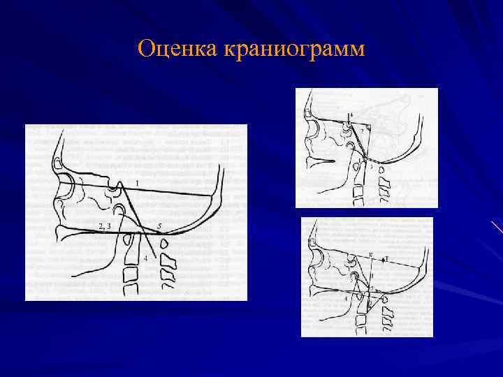 Оценка краниограмм 