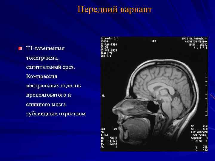 Передний вариант Т 1 -взвешенная томограмма, сагиттальный срез. Компрессия вентральных отделов продолговатого и спинного