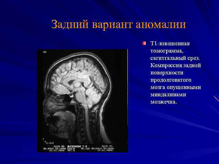 Задний вариант аномалии Т 1 -взвешенная томограмма, сагиттальный срез. Компрессия задней поверхности продолговатого мозга