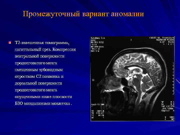 Промежуточный вариант аномалии Т 2 -взвешенная томограмма, сагиттальный срез. Компрессия вентральной поверхности продолговатого мозга