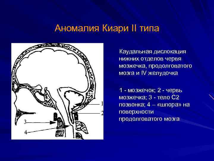 Аномалия Киари II типа Каудальная дислокация нижних отделов червя мозжечка, продолговатого мозга и IV