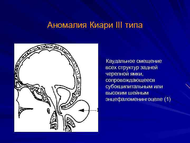 Аномалия Киари III типа Каудальное смещение всех структур задней черепной ямки, сопровождающееся субокципитальным или