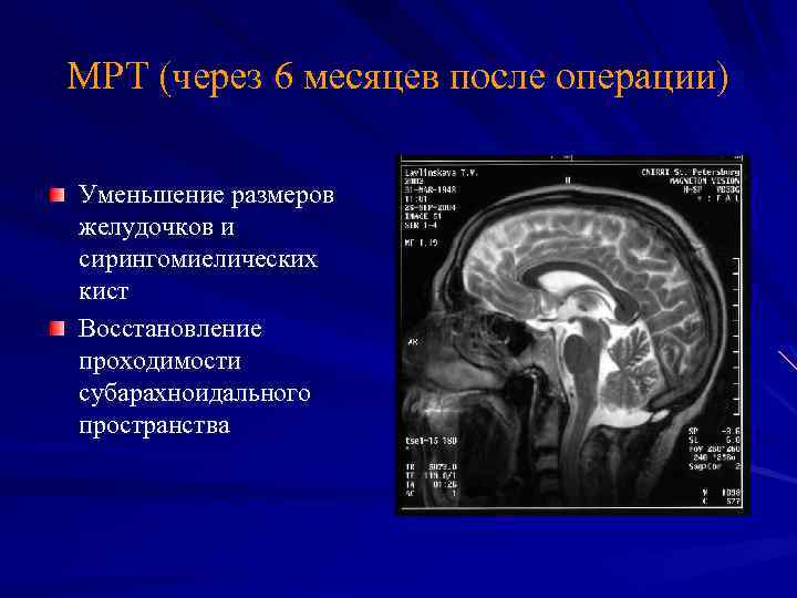 МРТ (через 6 месяцев после операции) Уменьшение размеров желудочков и сирингомиелических кист Восстановление проходимости