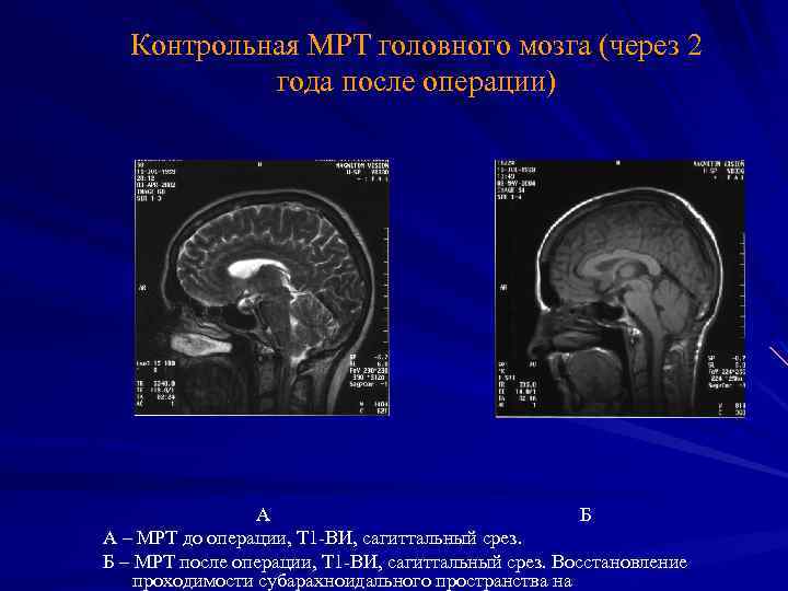 Контрольная МРТ головного мозга (через 2 года после операции) А Б А – МРТ